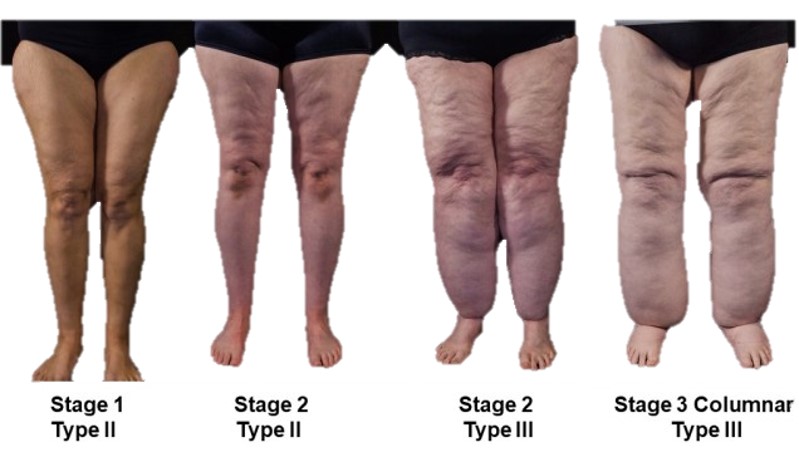 Stages of lipedema