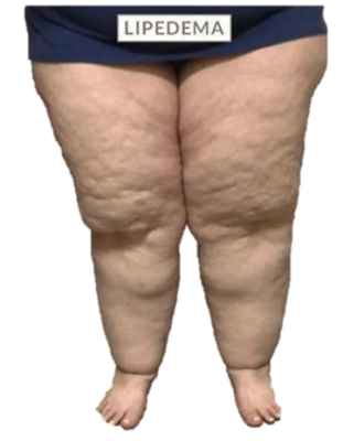 Lipedema