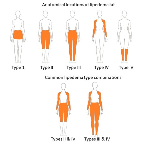 lipedema fat distribution